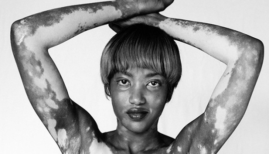 Discover the beauty of vitiligo