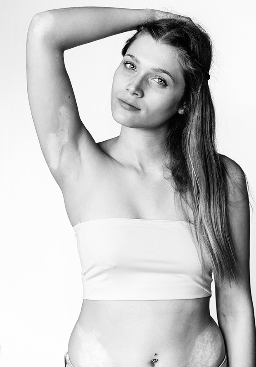 Discover the beauty of vitiligo Discover the beauty of vitiligo