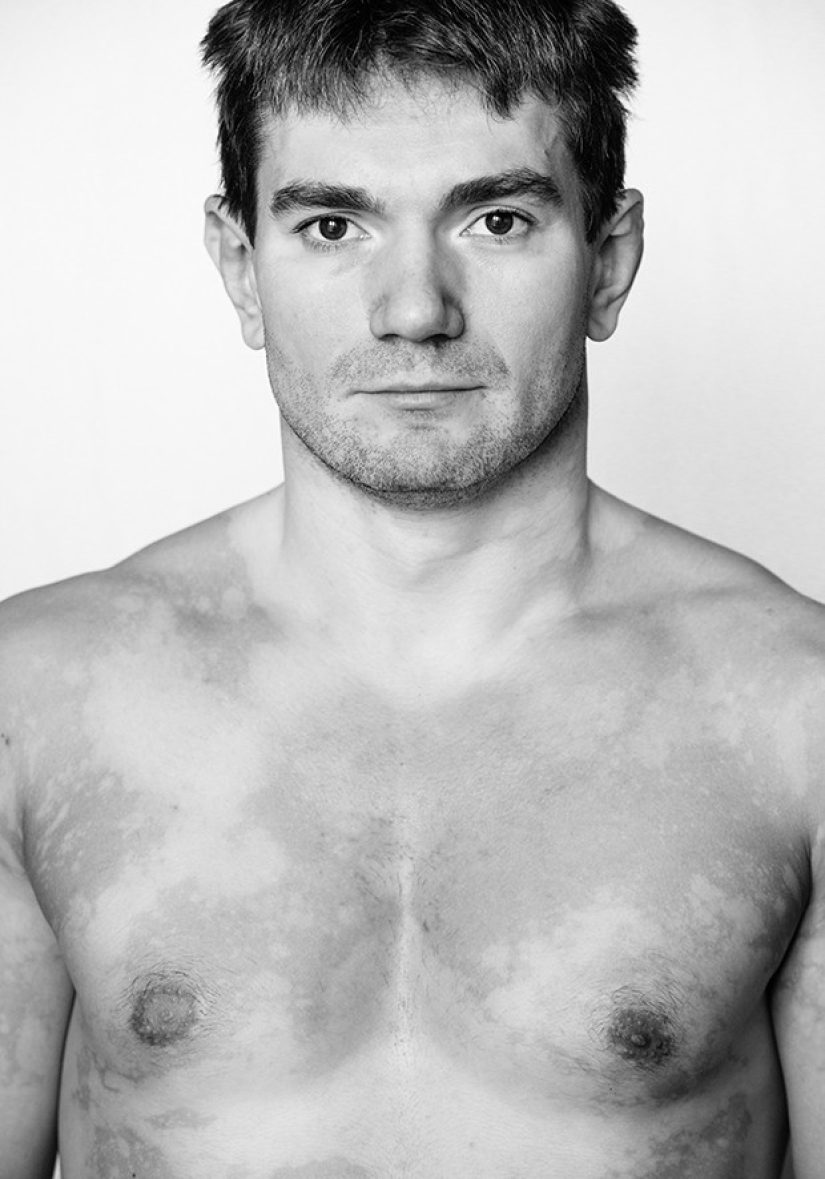 Discover the beauty of vitiligo Discover the beauty of vitiligo