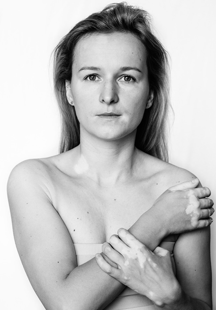 Discover the beauty of vitiligo Discover the beauty of vitiligo