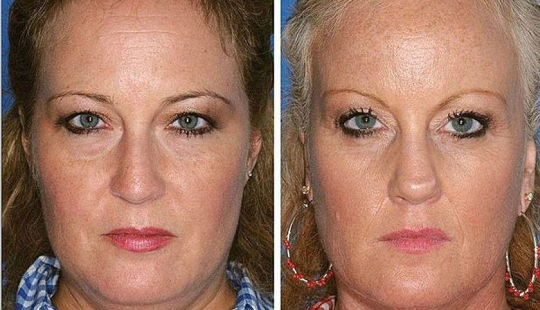 Efectos del tabaquismo en el ejemplo de los gemelos