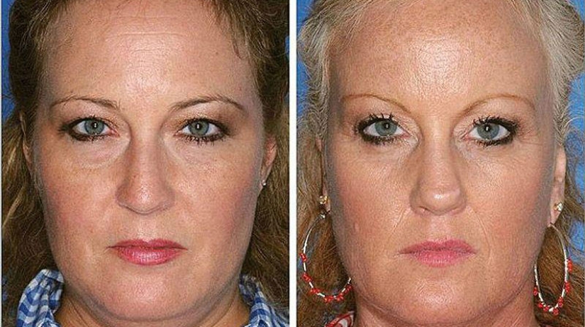 Effects of smoking on the example of twins Effects of smoking on the example of twins