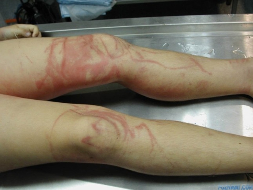 El toque de la mano de la muerte", o por Qué se bañan en pantimedias en el norte de Australia El toque de la mano de la muerte", o por Qué se bañan en pantimedias en el norte de Australia