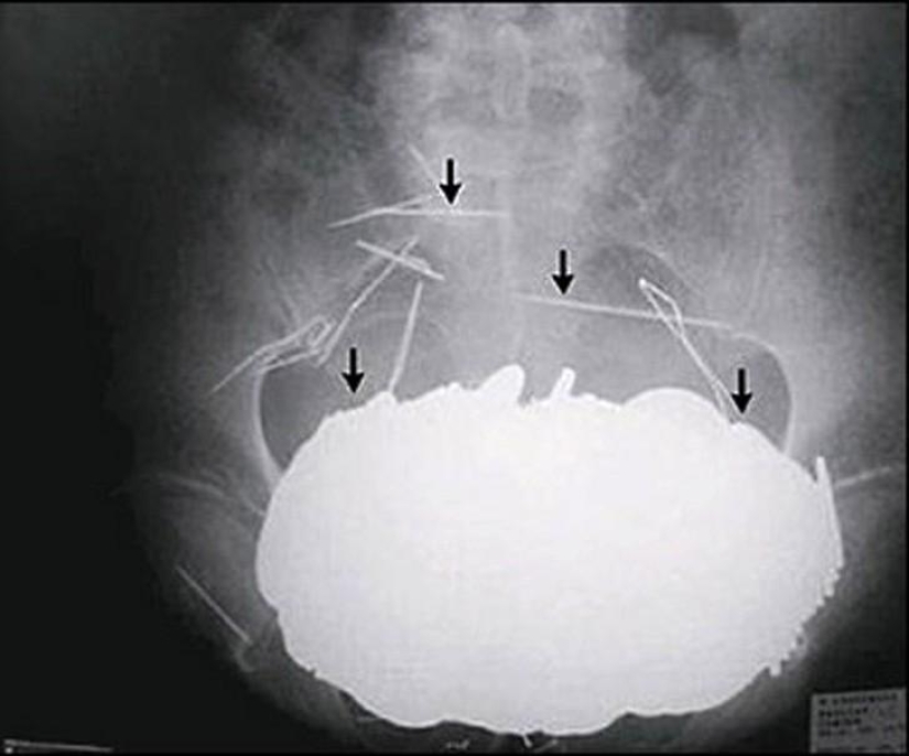 Los objetos más increíbles que se han encontrado en el cuerpo humano