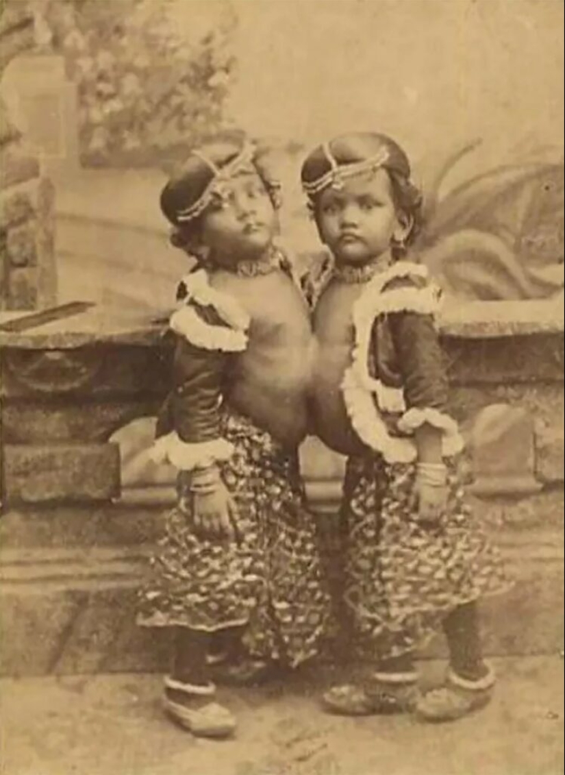 Radhika and Dudika Neik: The tragic fate of conjoined twins who were unfortunately separated