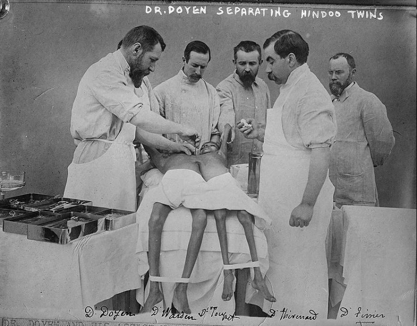 Radhika and Dudika Neik: The tragic fate of conjoined twins who were unfortunately separated