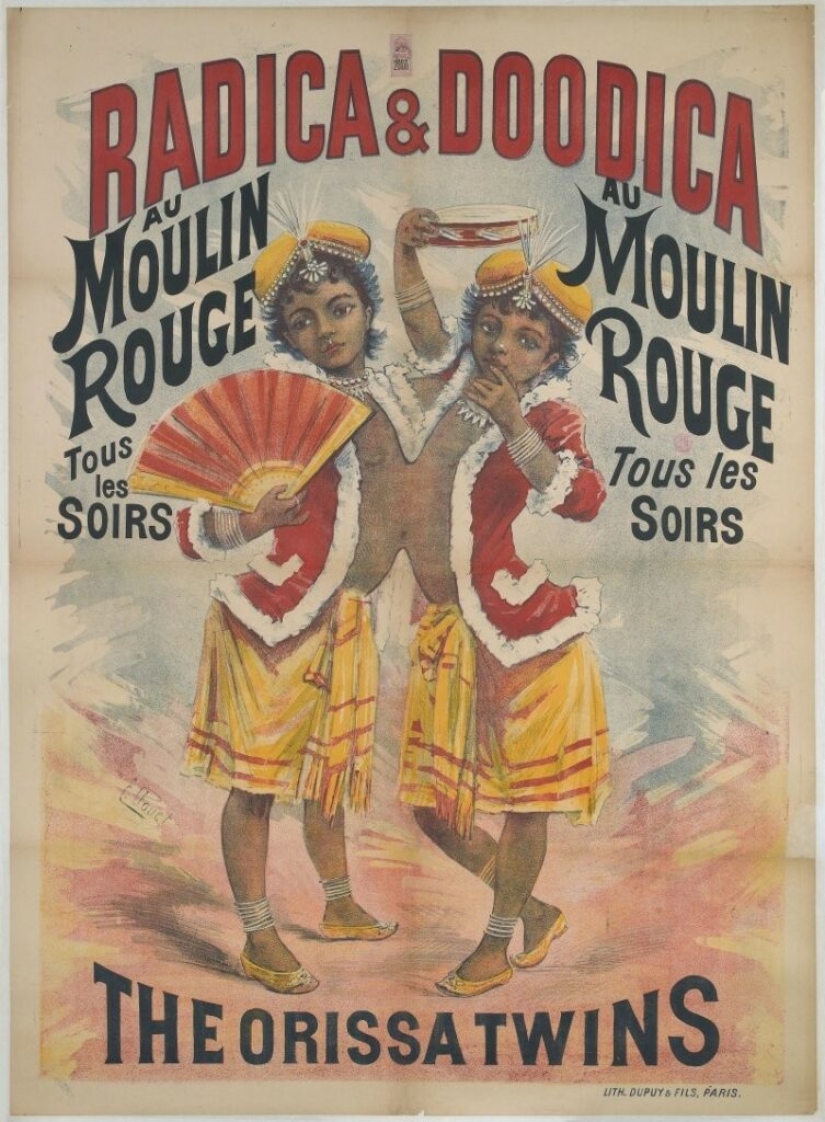 Radhika y Dudika Neik: El trágico destino de las siamesas que lamentablemente fueron separadas