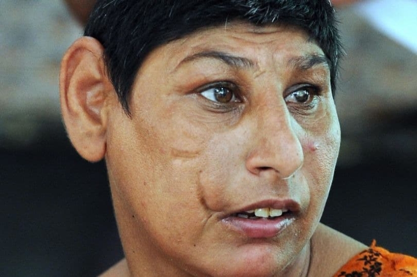 "Rats of Shah Daula": children from Pakistan with deformed skulls and a hard fate "Rats of Shah Daula": children from Pakistan with deformed skulls and a hard fate