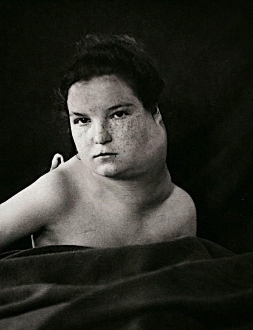 Retratos de dolor: impactantes fotografías de los pacientes a partir del siglo xix que sufren de enfermedades graves