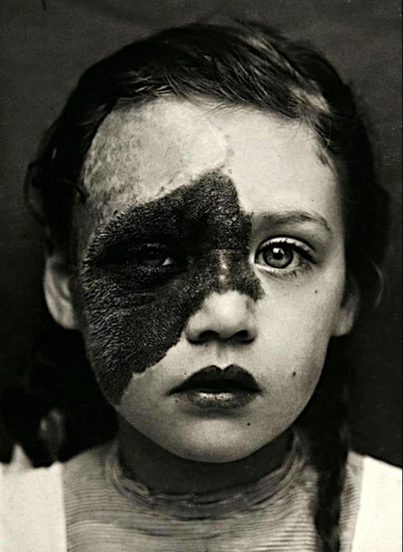 Retratos de dolor: impactantes fotografías de los pacientes a partir del siglo xix que sufren de enfermedades graves