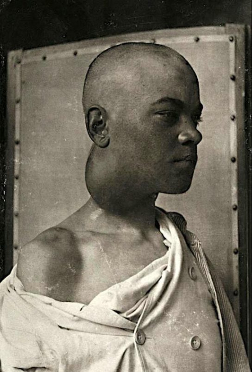 Retratos de dolor: impactantes fotografías de los pacientes a partir del siglo xix que sufren de enfermedades graves