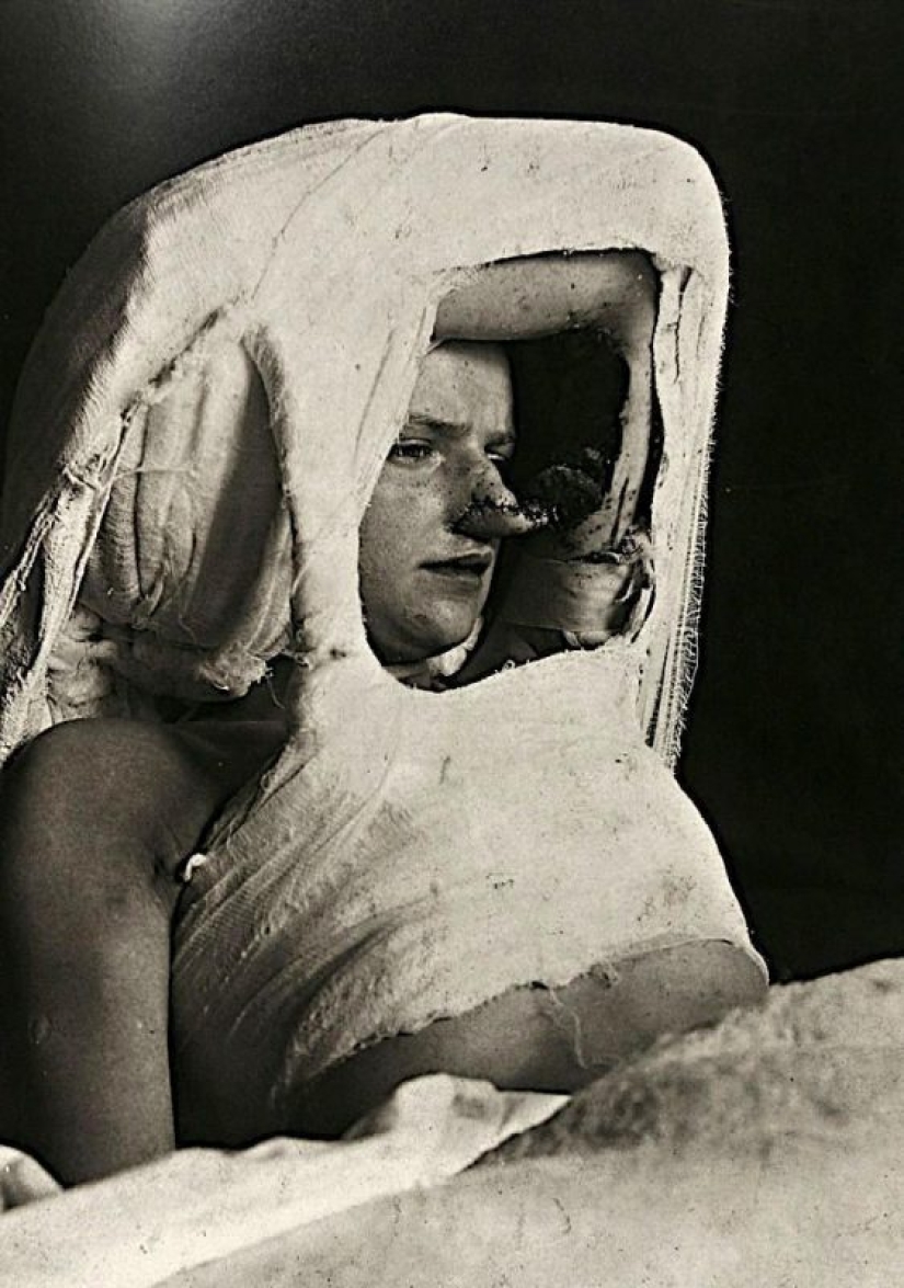 Retratos de dolor: impactantes fotografías de los pacientes a partir del siglo xix que sufren de enfermedades graves