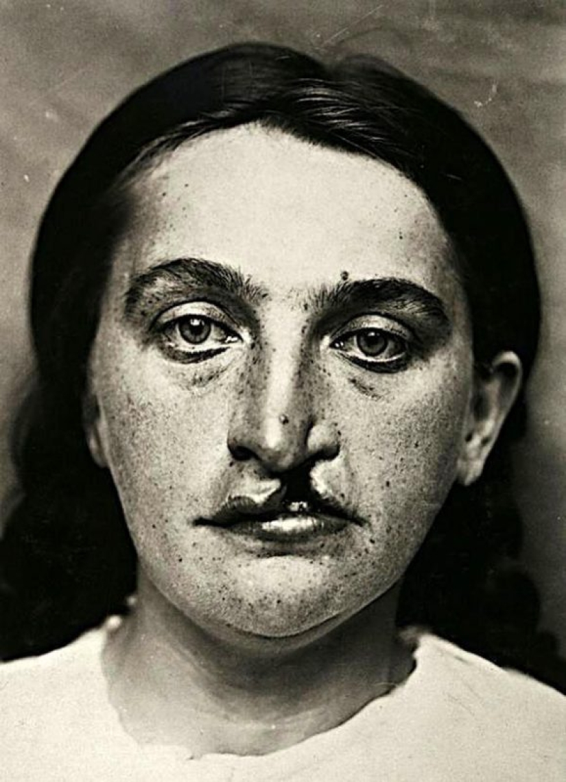 Retratos de dolor: impactantes fotografías de los pacientes a partir del siglo xix que sufren de enfermedades graves