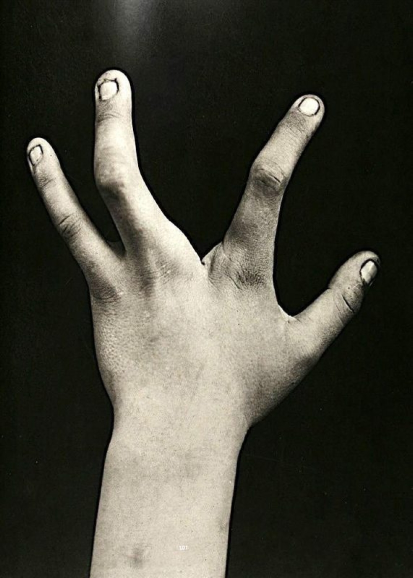 Retratos de dolor: impactantes fotografías de los pacientes a partir del siglo xix que sufren de enfermedades graves