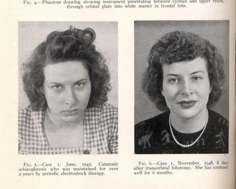 Terrible "medicina" de riñas y ninfomanía: Top 10 datos escalofriantes sobre las lobotomías Terrible "medicina" de riñas y ninfomanía: Top 10 datos escalofriantes sobre las lobotomías