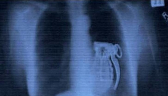 The most incredible objects that have been found in the human body The most incredible objects that have been found in the human body