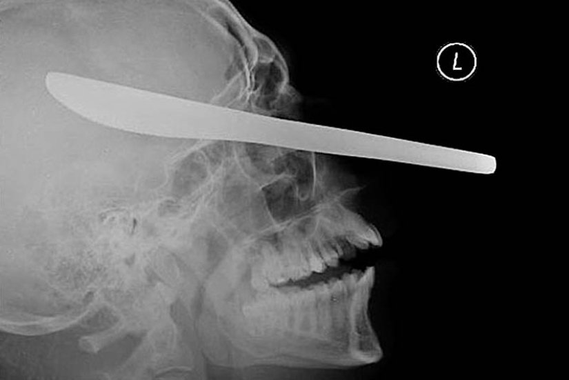 The strangest X-rays