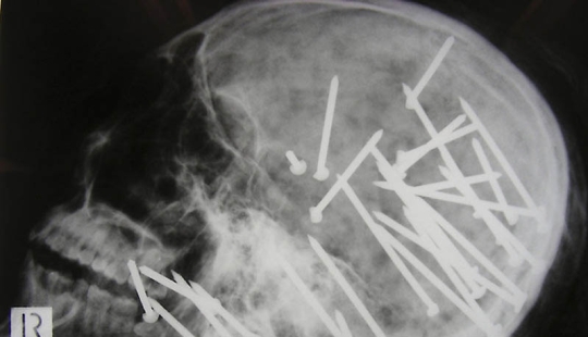 The strangest X-rays
