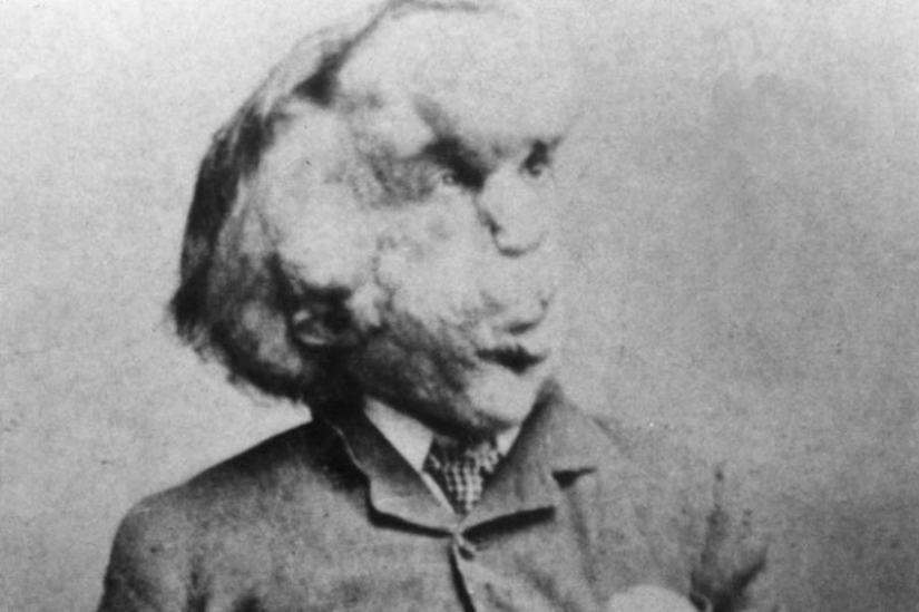 Un Fenómeno con un Alma Hermosa: La historia de Joseph Merrick - El Hombre Elefante Un Fenómeno con un Alma Hermosa: La historia de Joseph Merrick - El Hombre Elefante