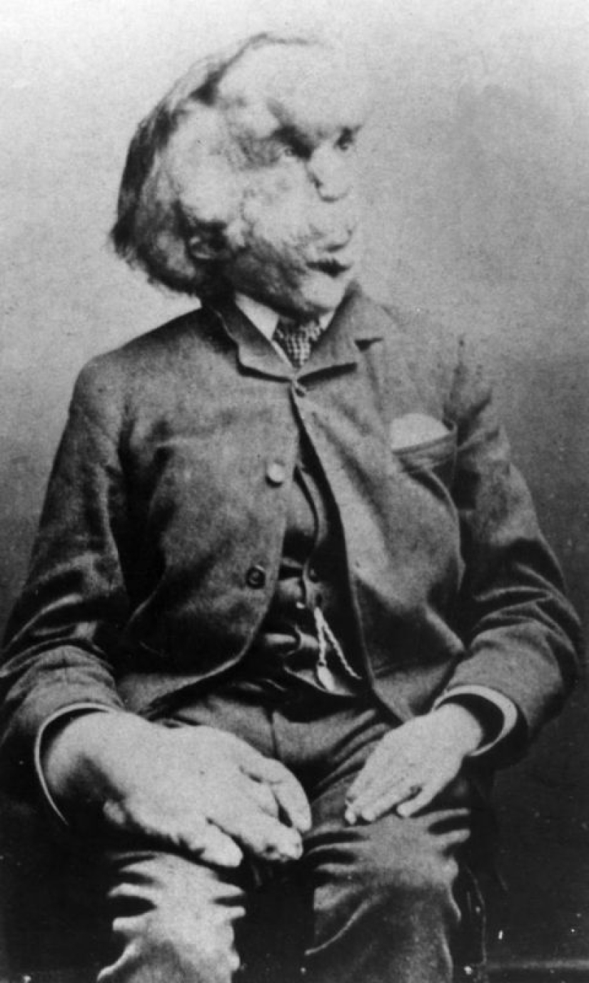 Un Fenómeno con un Alma Hermosa: La historia de Joseph Merrick - El Hombre Elefante Un Fenómeno con un Alma Hermosa: La historia de Joseph Merrick - El Hombre Elefante