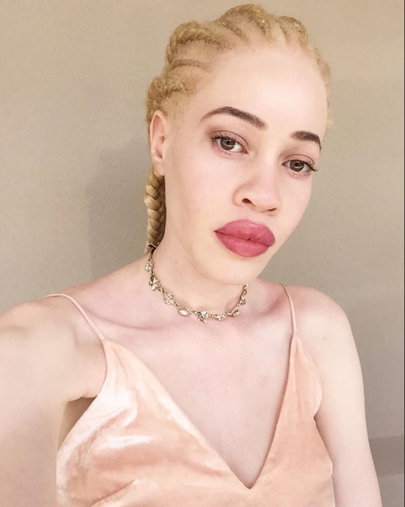 What do albinos of different nationalities and races look like What do albinos of different nationalities and races look like