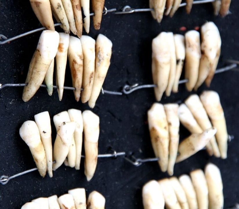 What is "Waterloo teeth", or As the battle of 1815 influenced the development of dentistry What is "Waterloo teeth", or As the battle of 1815 influenced the development of dentistry