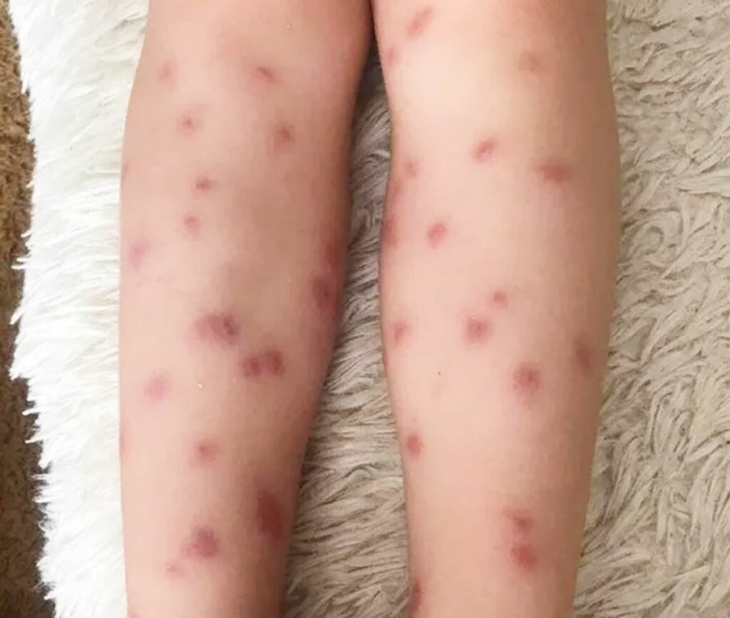 Why are cercariae dangerous - parasites from river water that penetrate the skin?